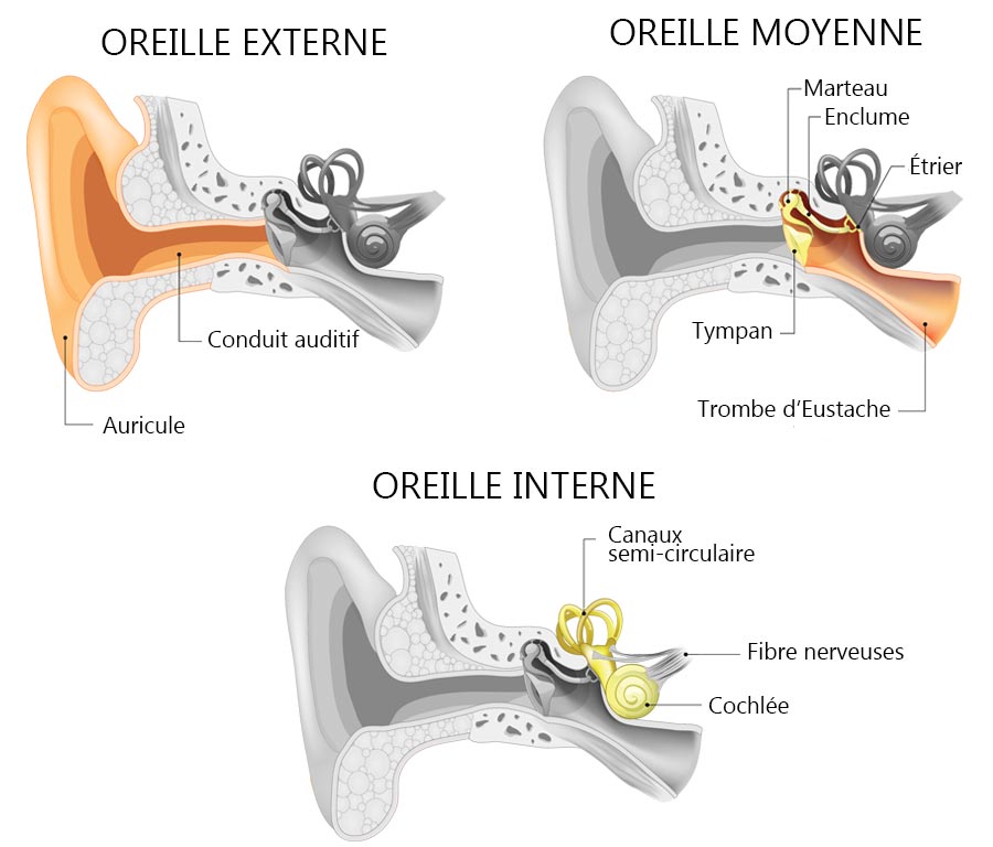 differentes otites