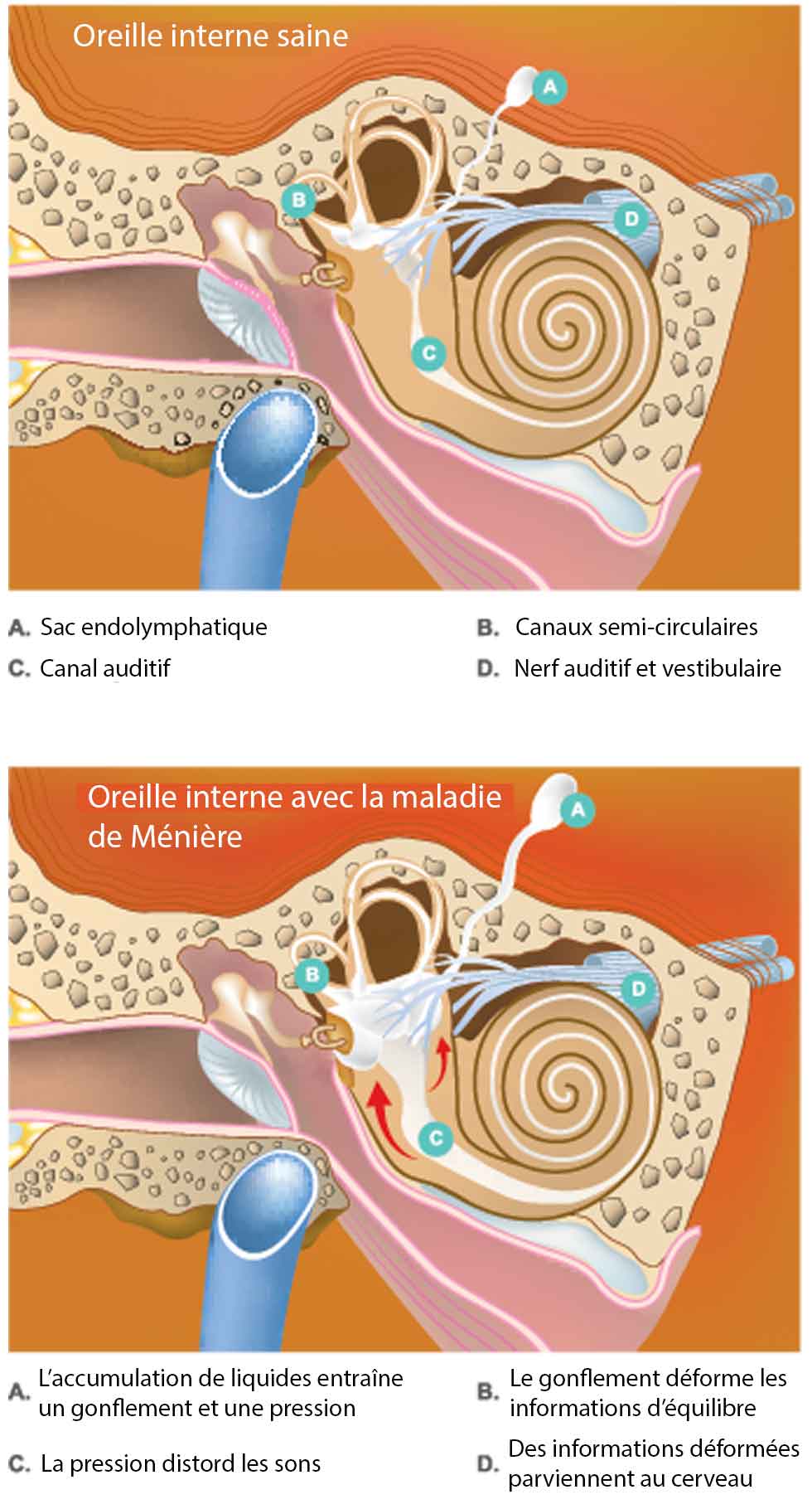 maladie-de-meniere